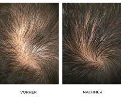 My general perception is the process of microneedling at the superficial level of hair in women may induce some inflammation, which causes the hair to go into telogen or shedding phase. Dr Cyj Hair Filler Prp For Hair Loss Costs Procedure Hamburg