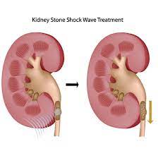 Cu el poți și trebuie să te lupți și. De Ce Facem Pietre La Rinichi