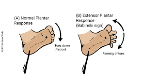 Image result for Babinski Reflex