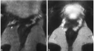 Mean Area Of The Levator Hiatus And Urogenital Hiatus At The Different Download Scientific Diagram