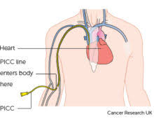 Kol Damar Tikanikligi Belirtileri Nedenleri Ve Tedavi Yontemleri