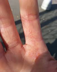 Image result for dyshidrosis