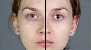 Yuzdeki Kahverengi Lekelerin Kesin Tedavisi Icin Bitkisel Dogal Maske Hanimlara Pratik Bilgiler Ve Puf Noktalari Dogal Cilt Photoshop Sivilce Izi