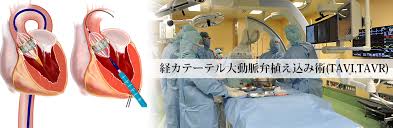 大動脈弁狭窄症により、障害更生年金3級が遡及で受給できた事例です。 請求日は人工弁装着で3級に決定も、障害認定日では不支給に。 事例53：心臓弁疾患 人工弁の装着がなくても3級に認定 （大動脈弁狭窄症、人工弁装着）. å€‰æ•·ä¸­å¤®ç—…é™¢ã®å¼è†œç—‡æ²»ç™‚ Tavi Mitraclipæ²»ç™‚