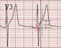 Image result for ST Elevation