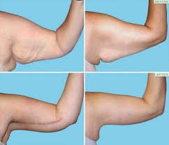 Brachioplasty Arm Lift Arm Liposuction Liposuction Body Lift Surgery