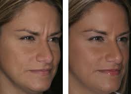 Botox Dysport Injections Before And After Fort Lauderdale Miami Boca Raton Dr Todd Sawisch Dysport Botox Botox Before And After