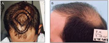 For many men and women. Update On Forelock Approach Of Hair Transplantation Hair Transplant Forum International