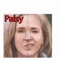 Image result for Progressive Bulbar Paralysis
