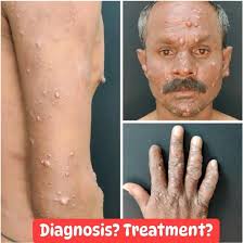 A 25-year-old man presents with this rash