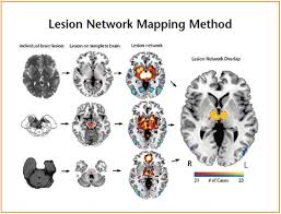 Image result for Neurologic Lesion Localization