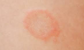 Ringworm is caused by a worm probably the most pervasive ringworm myth, this one stems from the. Ringworm On The Skin Village Emergency Centers