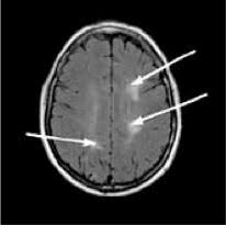 Krankheit, krankheitsfortschritt, mrt, ms, multiple sklerose. Die Diagnose Ms Ms Service