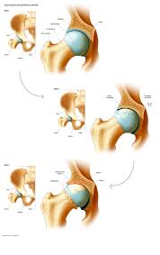 Une décision qui devrait accroître le recours aux prothèses de genoux, craignent les rhumatologues. Definition Symptomes Et Diagnostic De L Arthrose De Hanche Dr Paillard