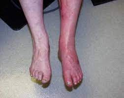 Leg Edema Treatment Austin Leg Ankle Foot Swelling Therapy