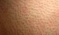 Home Laser Hair Removal Before And After