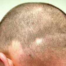 This infection causes lesions of the skin and bone and is. Hair Loss Comes And Goes Always Causing Distress Clinician Reviews