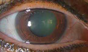 What Determines Transparency Or Haze After Corneal Wound Healing