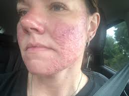 Lupus Awareness and Support