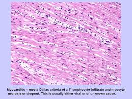 It can be an acute, subacute. Introduction To Cardiovascular Pathology Fred Clayton Ppt Video Online Download
