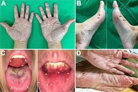 Image result for Hand foot and mouth disease HFMD roof of mouth
