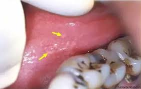 Sometimes you may notice bumps that occur after eating a hot meal. I Have Bumps Inside My Lips What Is It Quora