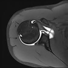 Image result for Shoulder MRI