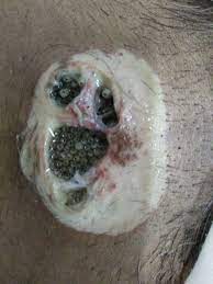 Parasites are organisms that live on or inside another organism (the host) and depend on the host for nutrition to live. Apprehension In Patient S Mind Leading To Myiasis Bmj Case Reports