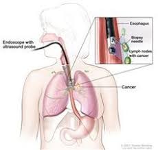 Diseases that attack these organs can cause serious health problems, so the sooner you know about them,. 30 Mesothelioma Draft Ideas Mesothelioma Cancer Lunges