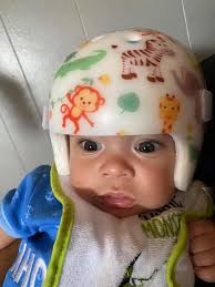 Skiing accident with a helmet in the Northeast