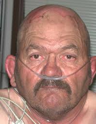 Telemedicine for Regional Burn Care