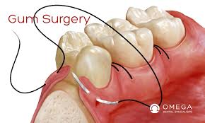 Jul 28, 2014 · for people with insurance, the copay usually ranges from $530 and up to $1,875, with a common average cost of $950 for every crown. The Cost Of Crown Lengthening In Houston Omega Dental Houston Tx