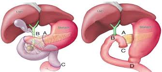 The Anatomy Of A Whipple Procedure Managing Pancreatic Cancer Let S Win