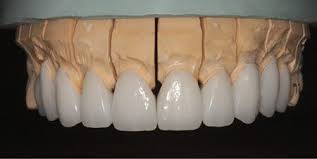 Figure 7 Final Restorations On The Working Model Dental Fun Veneers Teeth Dental Care