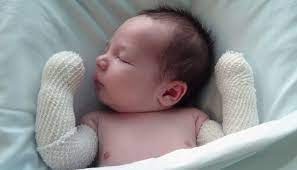 Fundacion Piel Sana Noticia Los Ninos Con Piel De Mariposa No Conocen Una Vida Sin Dolor