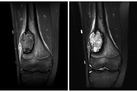 Image result for Osteosarcoma