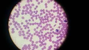 En la leucemia aguda las células son muy anormales y su número aumenta rápidamente. Lamina Leucemia Mieloide Cronica Youtube