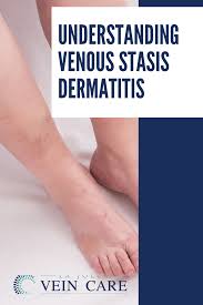 Image result for Stasis Dermatitis
