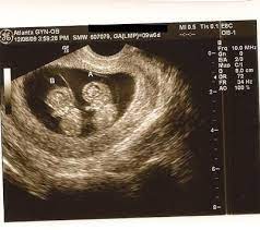6 week ultrasound identical twins. Identical Twins Ultrasound At 9w6d Twins Ultrasound Fraternal Twins Identical Twins