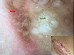 Image result for Dermatofibrosarcoma Protuberans