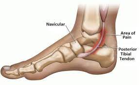 Check spelling or type a new query. Posterior Tibial Tendonitis Foot Pain Explored