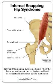 Snapping Hip Syndrome Information And Treatments Snapping Hip Syndrome Massage Therapy Hips