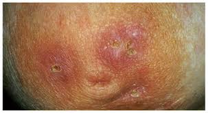 Le tissu des glandes mammaires de la chienne est particulièrement sensible à l'inflammation en période de changements hormonaux tels que la chaleur, une grossesse nerveuse, et la phase de lactation. Infections Du Sein