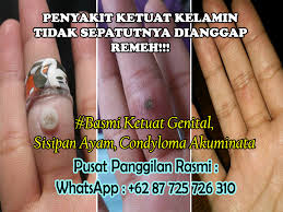 Pada masa ini, terdapat lebih daripada 100 virus ketuat yang berbeza. Ubat Ketuat Kaki Wart Punca Dan Rawatan Dengan Herba De Nature Solusi Ketuat Genital