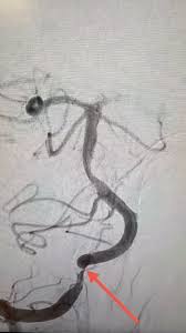 Patient in his 40s with history of severe dizziness, who was admitted for  further work up and found to have complete occlusion of the left vertebral  artery