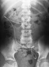 Plain Anteroposterior Radiography Of The Abdomen Showing The Serpentine Download Scientific Diagram