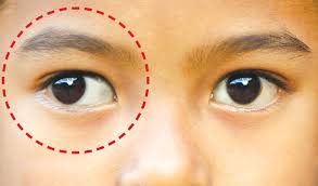 Kelopak mata kanan atas adalah bagian tubuh yang paling sering mengalami kedutan. Tip Menjaga Kesihatan Mata Anak