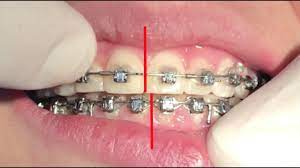 For adults seeking orthodontic care, it's commonly. Crossbites Centrelines And Elastic Wear Youtube