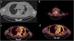 Since pet scans only show the where the most tracer fluid was collected, they are an excellent tool for determining how far mesothelioma has spread. Chest Ct Presenting Mesothelioma B C Axial Pet Images With Higher Download Scientific Diagram