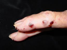 Bullous Disease Of Dialysis الداء الفقاعي الناتج عن التحال الدموي